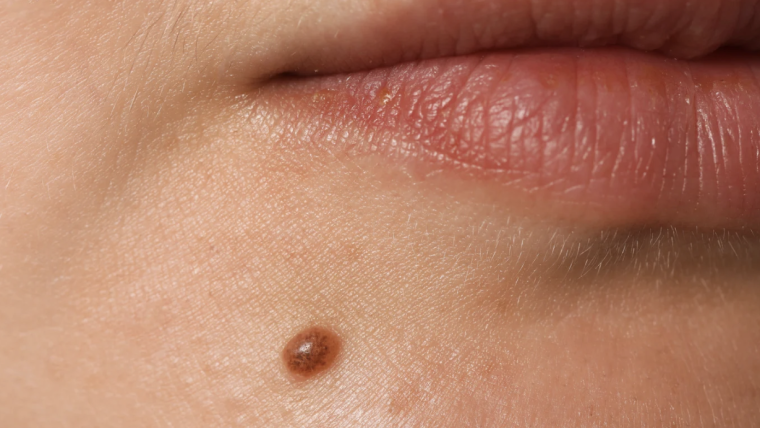 Mole Check Dermatology Appointment in Vienna, Virginia
